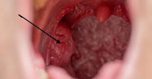 Healthy weight loss versus unhealthy weight loss physical appearance is extremely important to people in our society today. Holes In Tonsils Causes Symptoms And Treatment