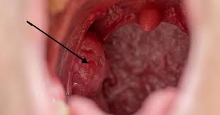 It's most common in children and can be caused by both viral and bacterial infections. Holes In Tonsils Causes Symptoms And Treatment