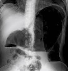 Image result for Megacolon