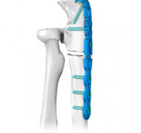 Anatomical Pelvic Acetabular Locking Plate,Medical Device ...
