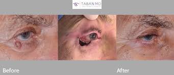 Eyelid Skin Cancer Before And After Photos Taban Md