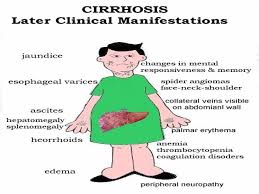 Cirrhosis Of The Liver And The Liver Functions Nursing Care Plan Nurse Medical Surgical Nursing