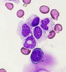 Mds ）とは 骨髄 機能の異常によって前 白血病 状態となり、 造血 障害を起こす 症候群 である。. éª¨é«„ç•°å½¢æˆç—‡å€™ç¾¤