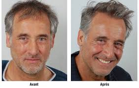 Certains hommes ont du mal à s'y faire et tentent vous gardez vos cheveux mais ils sont tondus de près. Astuce Comment Masquer Facilement La Calvitie
