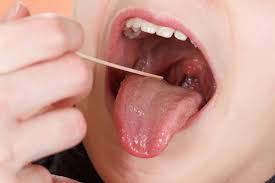 Image result for Tonsillitis