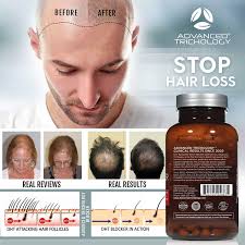Designed to stimulate existing hair follicles that are healthy enough to produce hair. Amazon Com Advanced Trichology Dht Blocker With Immune Support Hair Loss Supplements High Potency Saw Palmetto Green Tea Probiotics Gluten Free Vegetarian 120 Count Bottle 90 Day Moneyback Guarantee Health