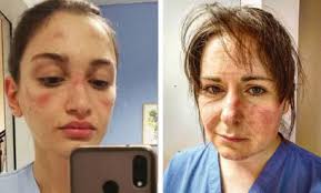 Skin damage: the personal cost of COVID-19 measures