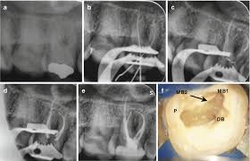 We did not find results for: Anatomy And Root Canal Morphology Basicmedical Key