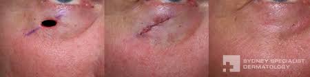 Thank you, {{form.email}}, for signing up. Gallery Mohs And Skin Cancer Surgery Sydney Specialist Dermatology
