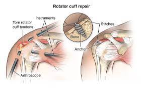 The rotator cuff tendons are a group of four tendons that connect the deepest layer of muscles to the biceps tendon begins at the top of the shoulder socket (the glenoid) and then passes across the. Rotator Cuff Injury Cedars Sinai