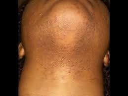 You can still shave and, in fact, you'll be asked to shave your treatment area 24 to 48 hours before your scheduled appointment. Get Rid Tattoo Easy Laser Hair Removal For Keratosis Pilaris