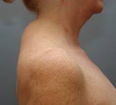 Aside from bad posture, probably either scoliosis or osteoporosis would be the most common causes for having a hump in your neck. Pictures Causes And Removal Of A Buffalo Hump Hubpages