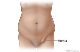 There's not many, maybe 3 or 4 at a time. Inguinal Hernia Repair Surgery What To Expect At Home