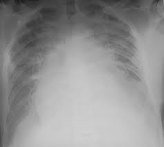 Chest Radiology Blood clot to the legs. chest radiology
