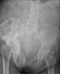 It can be caused both. Breast Cancer Pelvic Bony Metastases Radiology Case Radiopaedia Org