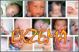 Ekzema pada bayi kebiasaannya disebut sebagai ruam dalam masyarakat. Penyakit Kulit Ekzema Pada Bayi Psoriasis Relaks Minda