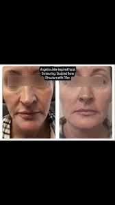 Enhancing the jawline with filler can do more than just define your lower  face — it can subtly lift sagging skin, reduce the appearance of jowls, and  soften marionette lines. By restoring structure ...