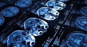 La aneurisma cerebral es una dilatación de una arteria dentro de la cabeza en forma de saco, baya o pera tomografía computada de cerebro en la que se observa la presencia de la típica hemorragia. Aneurisma Cerebral E Tratado Com Procedimento Inedito No Brasil Atualidades