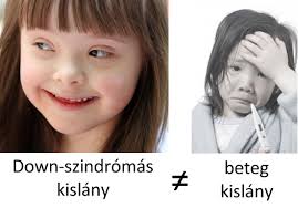 Langdon a külső megjelenés (a belső szemzugban megjelenő. A Down Szindroma Nem Betegseg Down Egyesulet