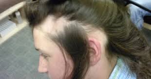 Telogen effluvium is another classic cause of hair loss in children in which surgery, a recent illness (typically with a high fever), sudden weight loss, or emotional stress triggers the spontaneous loss of hair six to 12 weeks later. Genetic Factors And Psychological Pressure Causes Of Alopecia In Children