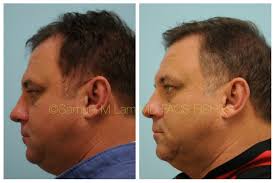 This 51 Year Old Man Who Is Shown Before And 2 Years After Hair Transplant To The Hairline Hair Transplant Procedure Hair Today Gone Tomorrow Hair Loss Women