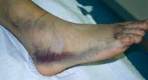 Une entorse se traduit par un traumatisme des ligaments. Artss Recherche En Traumatologie Et Suivi Sportif