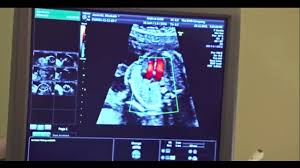 What is meant by dating in tamil. Anomaly Scan 21 Weeks 23 Weeks Youtube