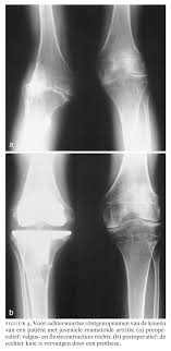 Sprzedajemy wyłącznie oryginalne produkty wspierające twoje zdrowie i urodę. Honderd Jaar Orthopedie In Nederland Vi Reumachirurgie Nederlands Tijdschrift Voor Geneeskunde
