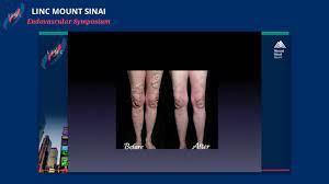 May Thurner Syndrome How To Diagnose And Treat Youtube