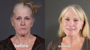 My Facelift Journey With Dr. Scott Holley