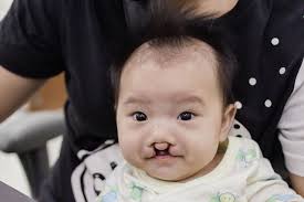 Cleft Success Story