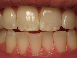 Image result for dental fluorosis