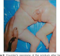 Browse 315 gangrene stock photos and images available or search for gas gangrene or fournier gangrene to find more great stock photos and pictures. Necrotizing Scrotum Fasciitis Fournier S Gangrene In An Infant A Case Report And Review Of The Literature Semantic Scholar
