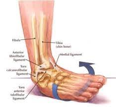 Torn Ligaments In Ankle - Do You Suspect You Have Torn Your Ligaments