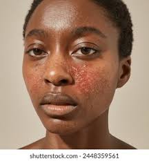 Image result for ekzema face