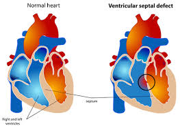 Other heart murmurs are caused by problems with the heart. Ventricular Septal Defect Vsd Child Heart Specialist