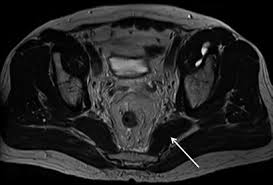 There are many muscles that form the pelvic floor, including puborectalis, pubococcygeus, iliococcygeus and coccygeus. 20 Piriformis Muscle Mri T2 Sequence Download Scientific Diagram