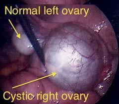 Ini merupakan gejala mental yang membuat pengidapnya mengalami kebingungan berat dan kesadaran yang berkurang akibat. Ovarian Cyst Bahaya Apakah Tanda Tanda Risiko Dan Rawatannya Legasi Kekja