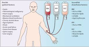 Image result for Transfusion Associated Circulatory Overload