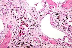 Check spelling or type a new query. Malignant Mesothelioma Marker Selection