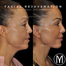 🤯Tina just got featured in @people!!! Senior Style News Editor Hedy  Phillips messaged me a few weeks ago when Tina's deep plane facelift and  deep necklift transformation went viral. She (@justhedyj) then