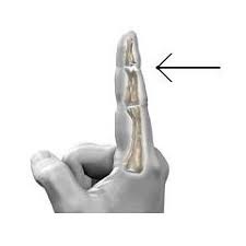 Doyle's classification of mallet finger injuries. Stax Finger Splints For Sale Size 1 7 Protect Fingertips