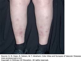 Image result for Panniculitis