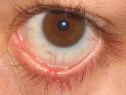 как лечить ячмень на нижнем веке в домашних условиях Pisyak Na Glazu Prichiny Vozniknoveniya Simptomy I Metody Lecheniya