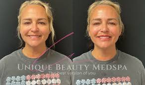 Lip Fillers Near Valrico