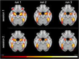 Comments for chapter chapter 136: Reproducibility Of Amygdala Fmri Fmri At Neuroimaging Stimulation