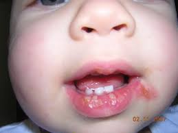 What does it mean ?, understand me in brief.he has rashes on. Cold Sores Baby Rash Hq