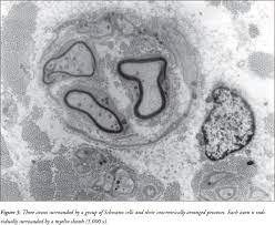 Dejerine Sottas Disease A Case Report