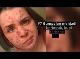 Sebelum saya terangkan cara yang mudah dan berkesan untuk anda hilangkan parut chickenpox anda, saya akan terangkan serba sedikit tentang penyakit ini. Makanan Untuk Cacar Air Chicken Pox Rawatan Doctoroncall