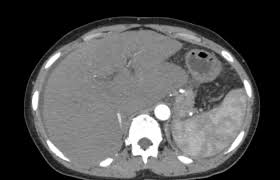 Budd Chiari Syndrome Radiology Case Radiopaedia Org